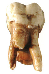 molar.jpg